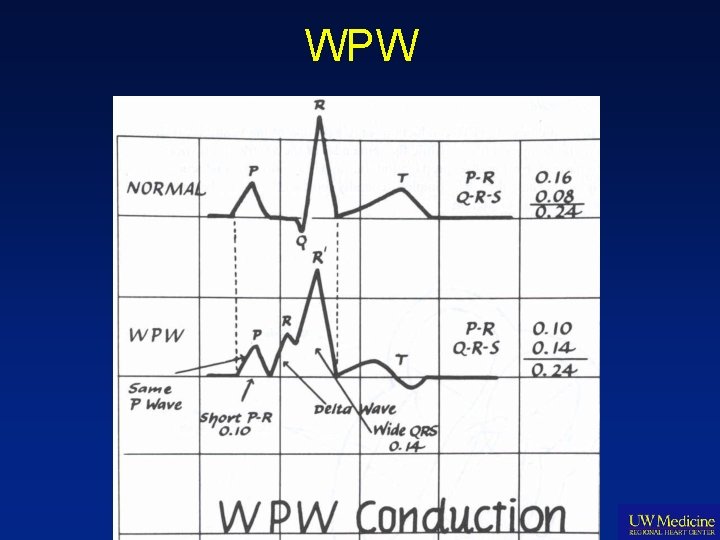 WPW 