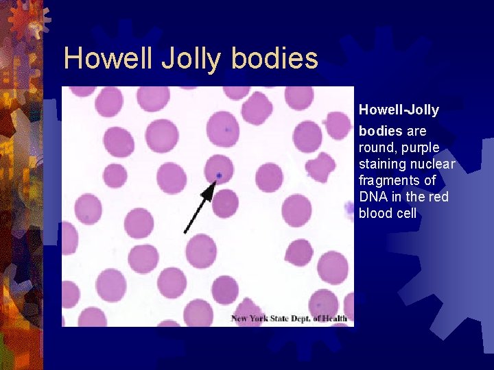 Howell Jolly bodies Howell-Jolly bodies are round, purple staining nuclear fragments of DNA in