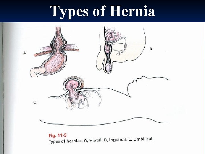 Types of Hernia 