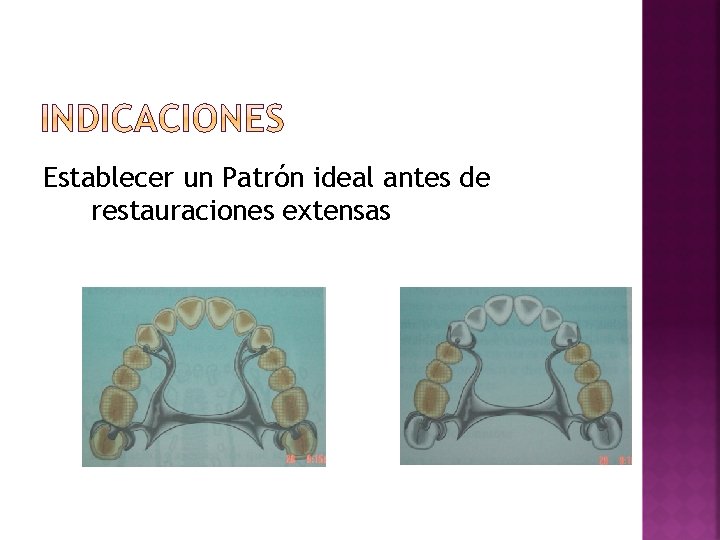 Establecer un Patrón ideal antes de restauraciones extensas 