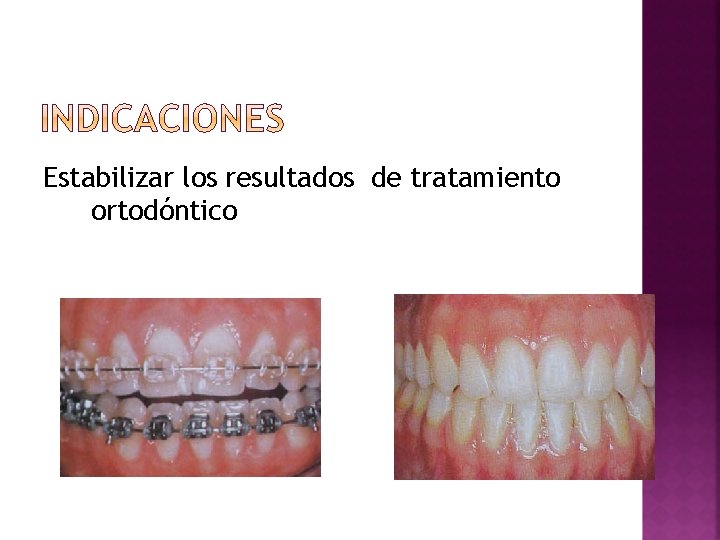 Estabilizar los resultados de tratamiento ortodóntico 