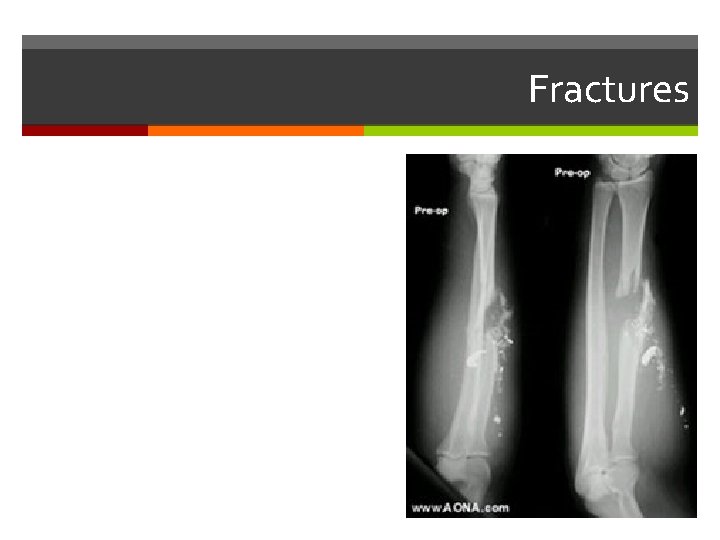 Fractures 