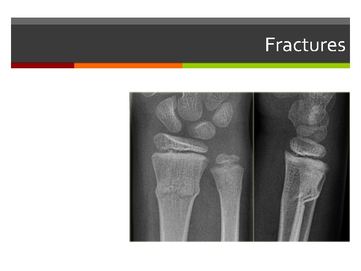 Fractures 