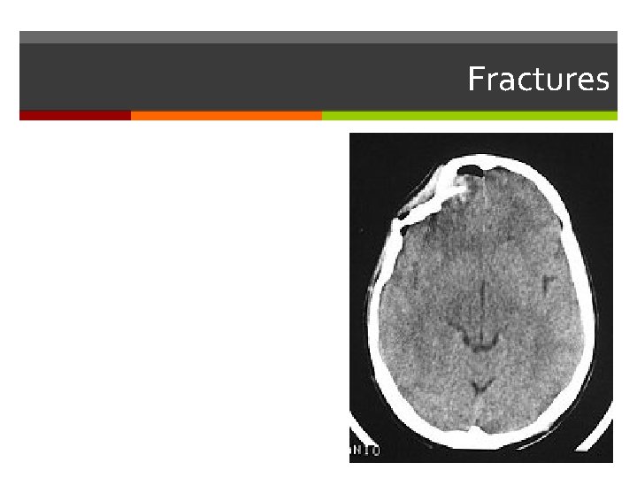 Fractures 