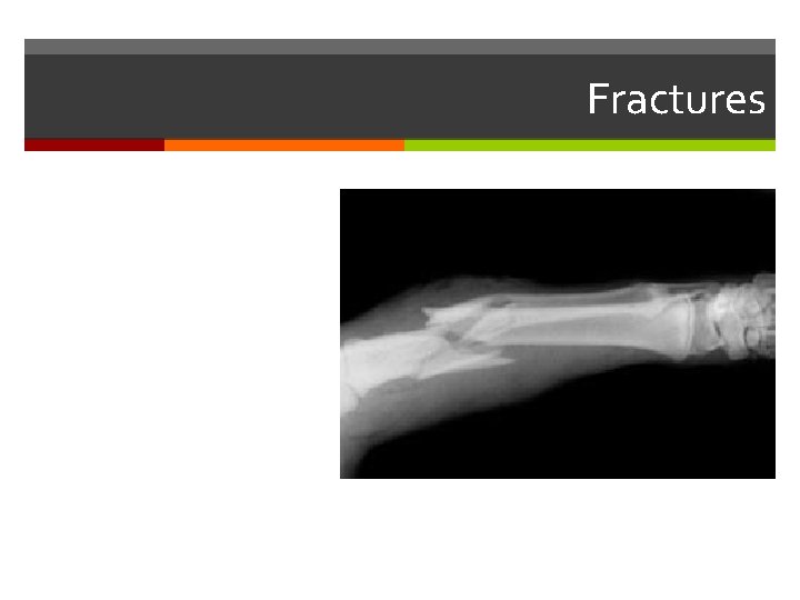 Fractures Fractures