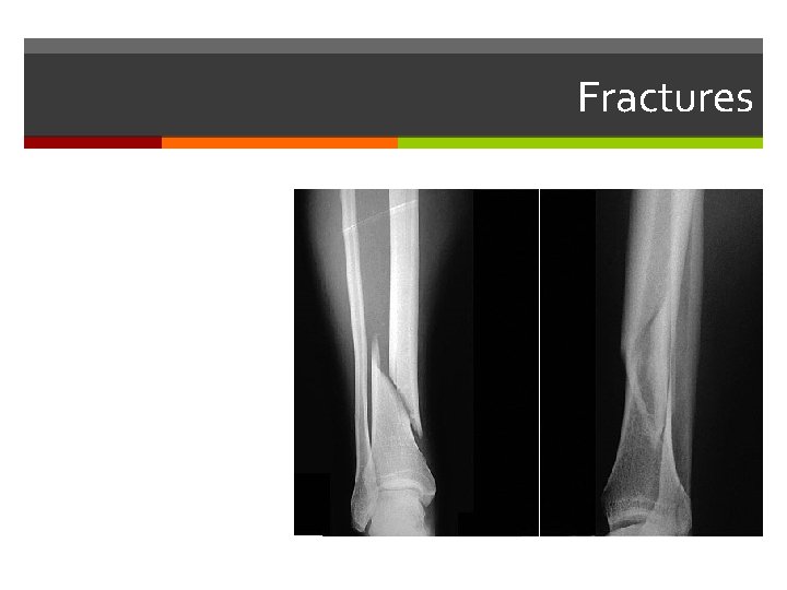 Fractures Fractures