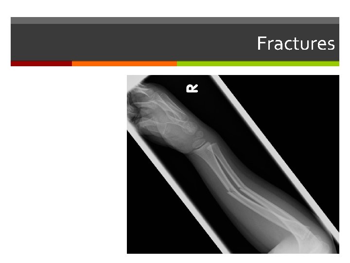 Fractures Fractures