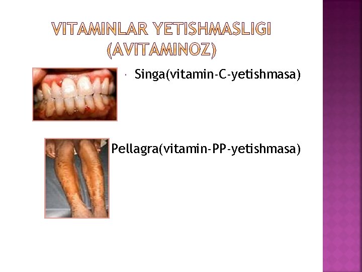  Singa(vitamin-C-yetishmasa) Pellagra(vitamin-PP-yetishmasa) 