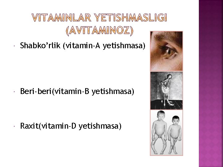  Shabko’rlik (vitamin-A yetishmasa) Beri-beri(vitamin-B yetishmasa) Raxit(vitamin-D yetishmasa) 