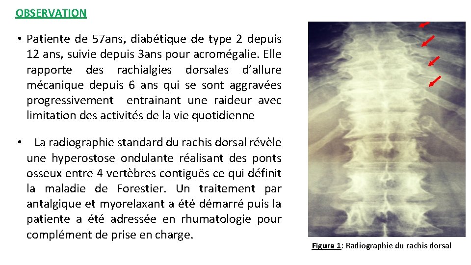 OBSERVATION • Patiente de 57 ans, diabétique de type 2 depuis 12 ans, suivie OBSERVATION • Patiente de 57 ans, diabétique de type 2 depuis 12 ans, suivie