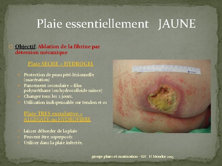 Plaie essentiellement JAUNE � Objectif: Ablation de la fibrine par détersion mécanique Plaie SECHE