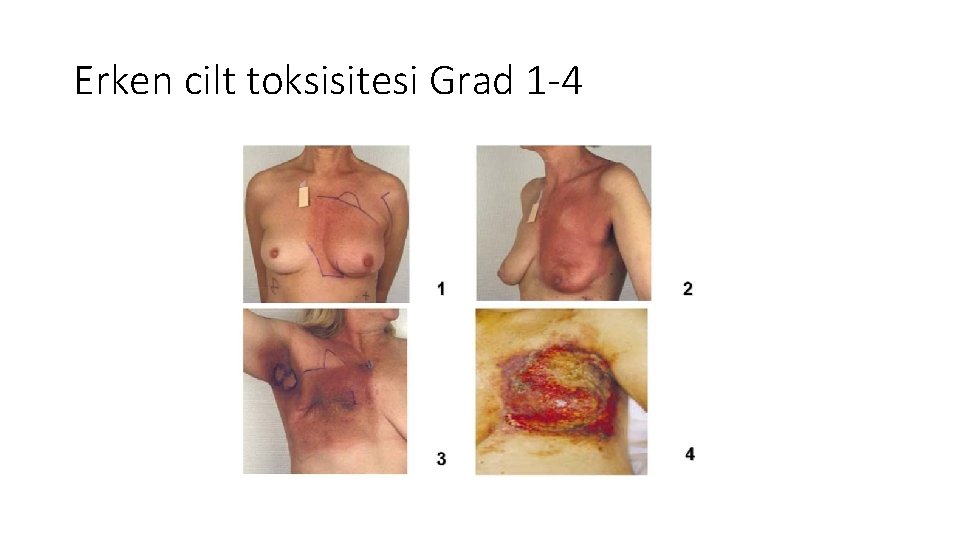 Erken cilt toksisitesi Grad 1 -4 Erken cilt toksisitesi Grad 1 -4