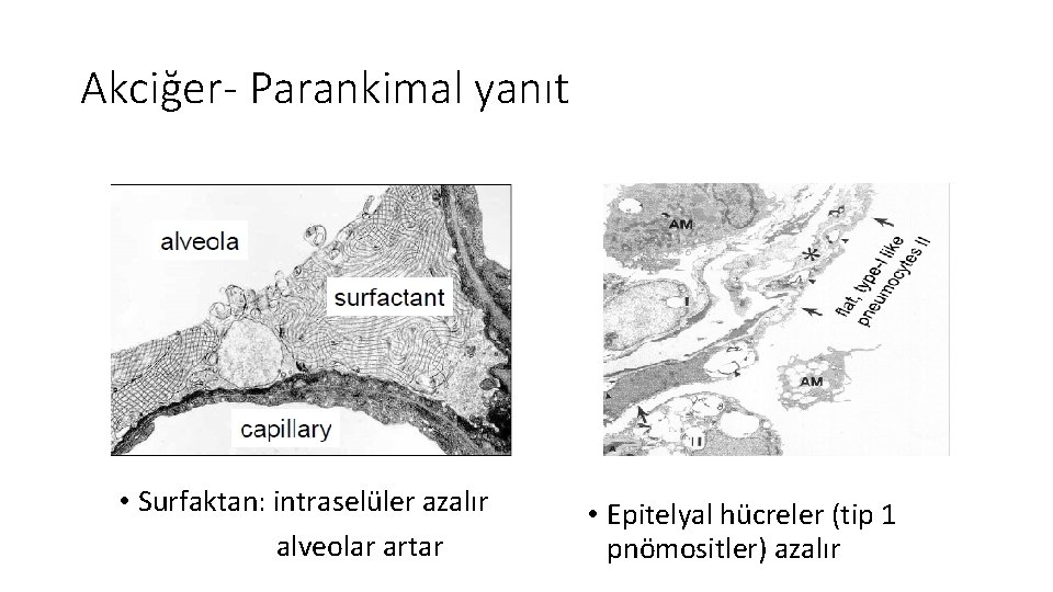 Akciğer- Parankimal yanıt • Surfaktan: intraselüler azalır alveolar artar • Epitelyal hücreler (tip 1 Akciğer- Parankimal yanıt • Surfaktan: intraselüler azalır alveolar artar • Epitelyal hücreler (tip 1