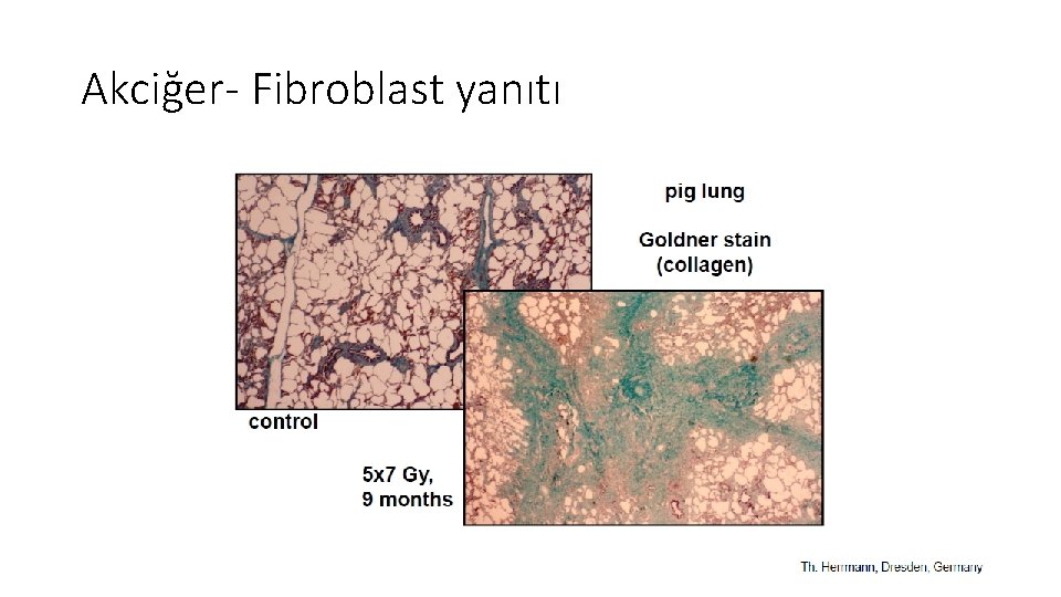 Akciğer- Fibroblast yanıtı Akciğer- Fibroblast yanıtı