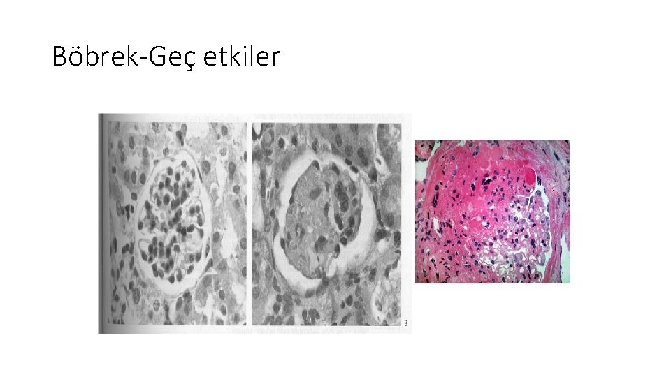 Böbrek-Geç etkiler Böbrek-Geç etkiler