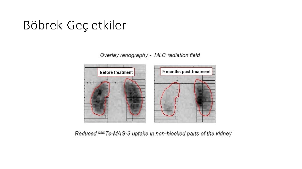 Böbrek-Geç etkiler Böbrek-Geç etkiler
