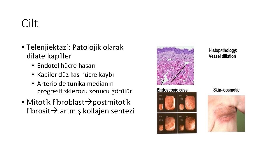 Cilt • Telenjiektazi: Patolojik olarak dilate kapiller • Endotel hücre hasarı • Kapiler düz Cilt • Telenjiektazi: Patolojik olarak dilate kapiller • Endotel hücre hasarı • Kapiler düz