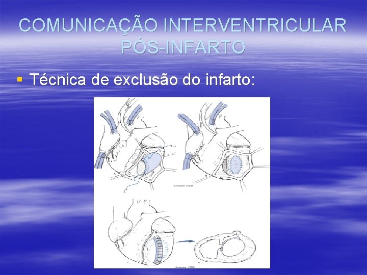 COMUNICAÇÃO INTERVENTRICULAR PÓS-INFARTO § Técnica de exclusão do infarto: 
