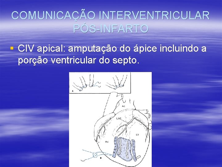 COMUNICAÇÃO INTERVENTRICULAR PÓS-INFARTO § CIV apical: amputação do ápice incluindo a porção ventricular do