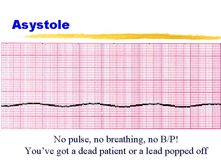 Asystole No pulse, no breathing, no B/P! You’ve got a dead patient or a