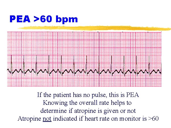 PEA >60 bpm If the patient has no pulse, this is PEA Knowing the