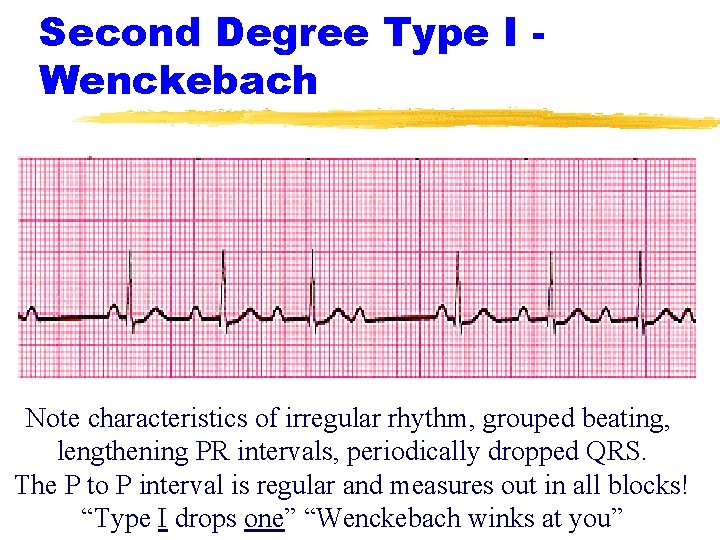 Second Degree Type I Wenckebach Note characteristics of irregular rhythm, grouped beating, lengthening PR