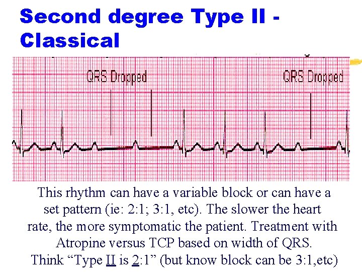 Second degree Type II Classical This rhythm can have a variable block or can Second degree Type II Classical This rhythm can have a variable block or can