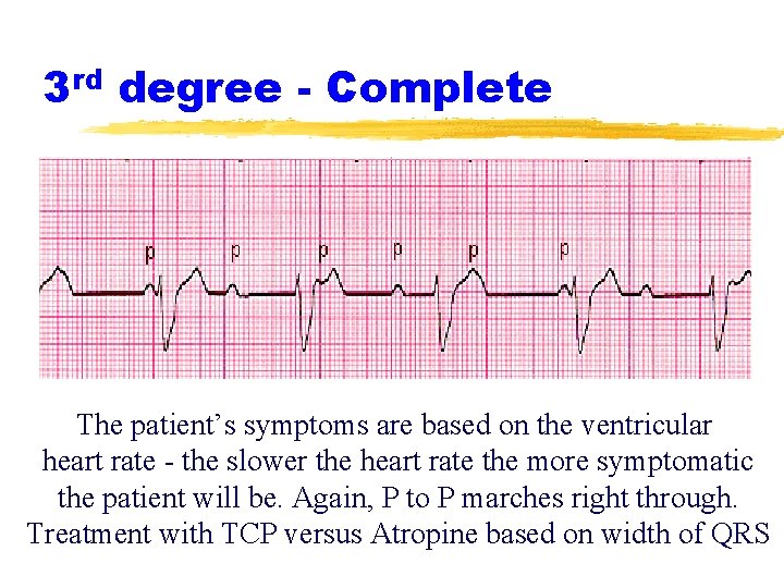 3 rd degree - Complete The patient’s symptoms are based on the ventricular heart