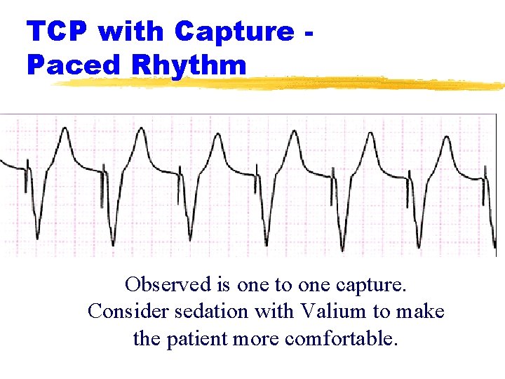 TCP with Capture Paced Rhythm Observed is one to one capture. Consider sedation with TCP with Capture Paced Rhythm Observed is one to one capture. Consider sedation with