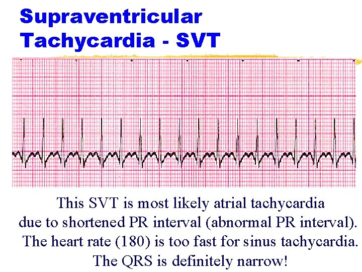 Supraventricular Tachycardia - SVT This SVT is most likely atrial tachycardia due to shortened