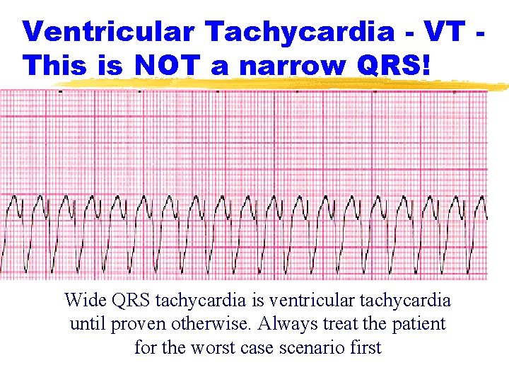 Ventricular Tachycardia - VT This is NOT a narrow QRS! Wide QRS tachycardia is