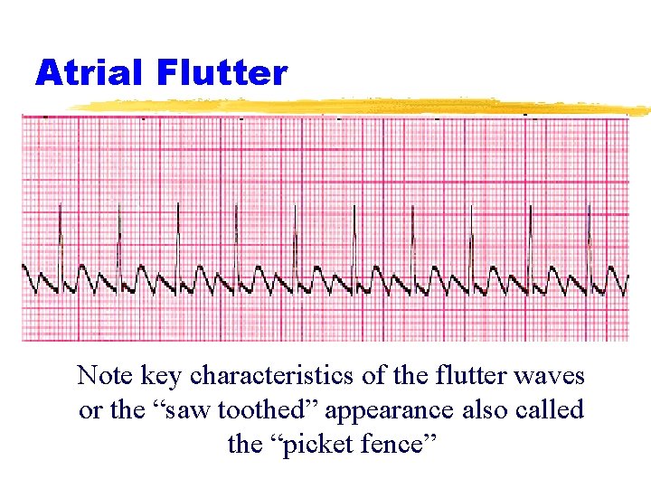 Atrial Flutter Note key characteristics of the flutter waves or the “saw toothed” appearance
