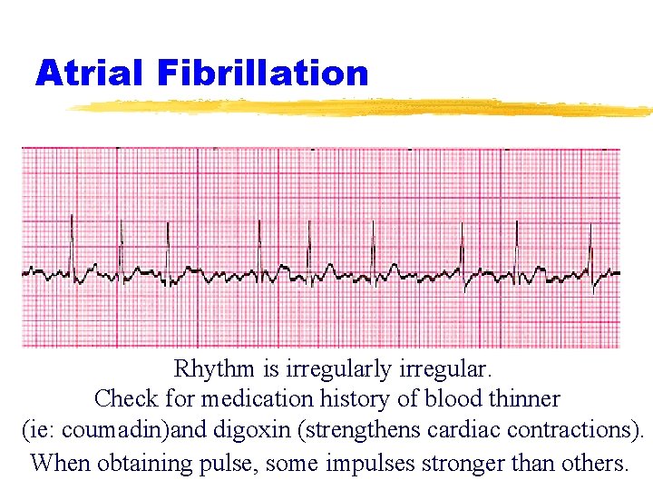 Atrial Fibrillation Rhythm is irregularly irregular. Check for medication history of blood thinner (ie: