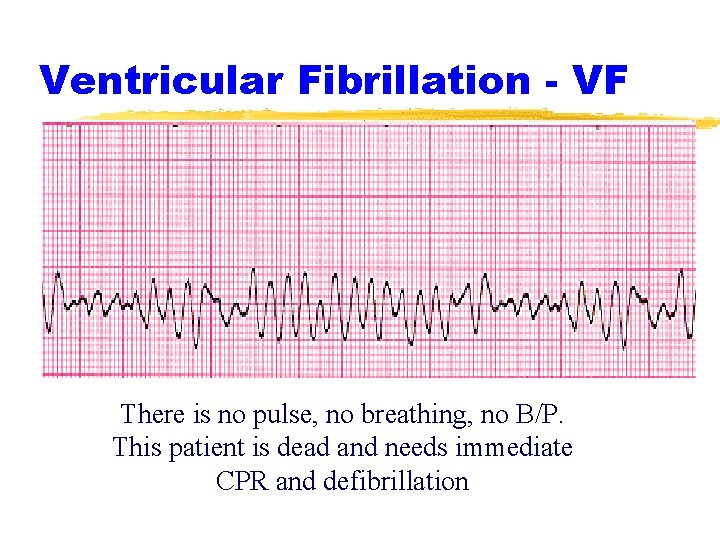 Ventricular Fibrillation - VF There is no pulse, no breathing, no B/P. This patient