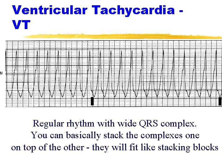 Ventricular Tachycardia VT Regular rhythm with wide QRS complex. You can basically stack the