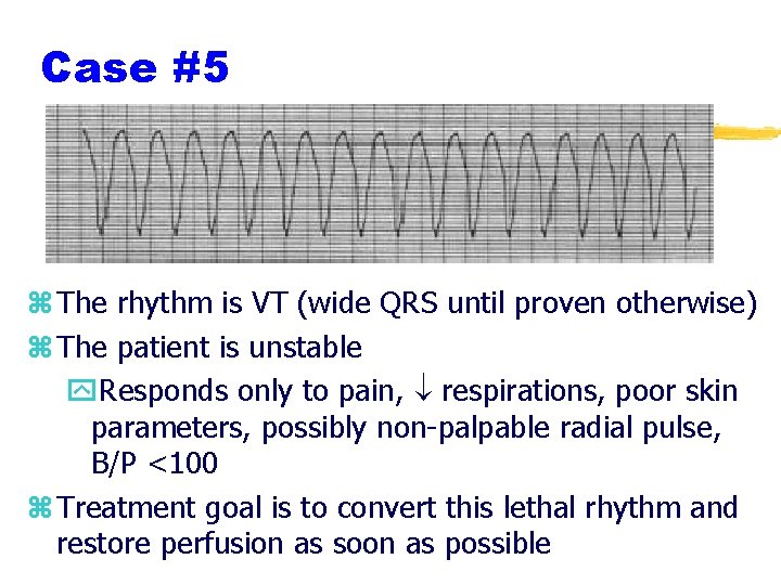 Case #5 z The rhythm is VT (wide QRS until proven otherwise) z The