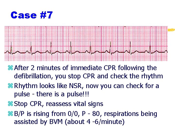 Case #7 z After 2 minutes of immediate CPR following the defibrillation, you stop