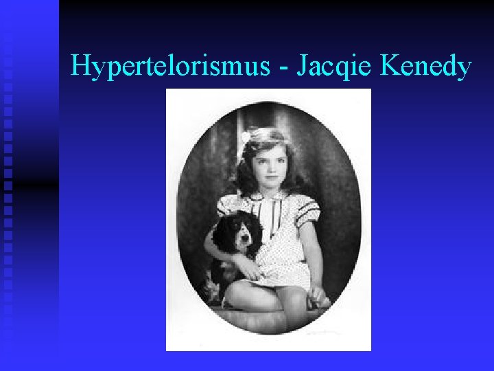 Hypertelorismus - Jacqie Kenedy 