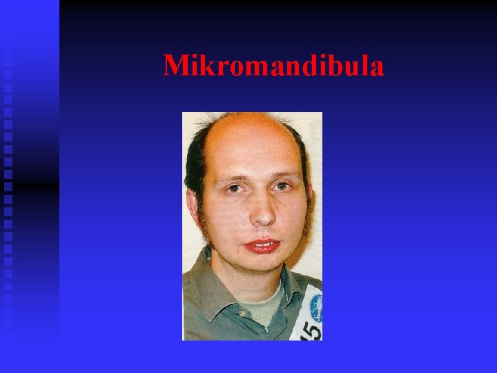 Mikromandibula 