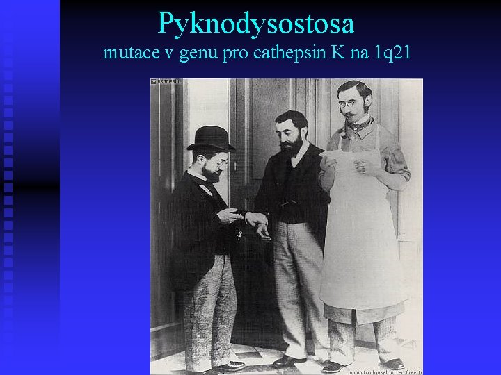 Pyknodysostosa mutace v genu pro cathepsin K na 1 q 21 