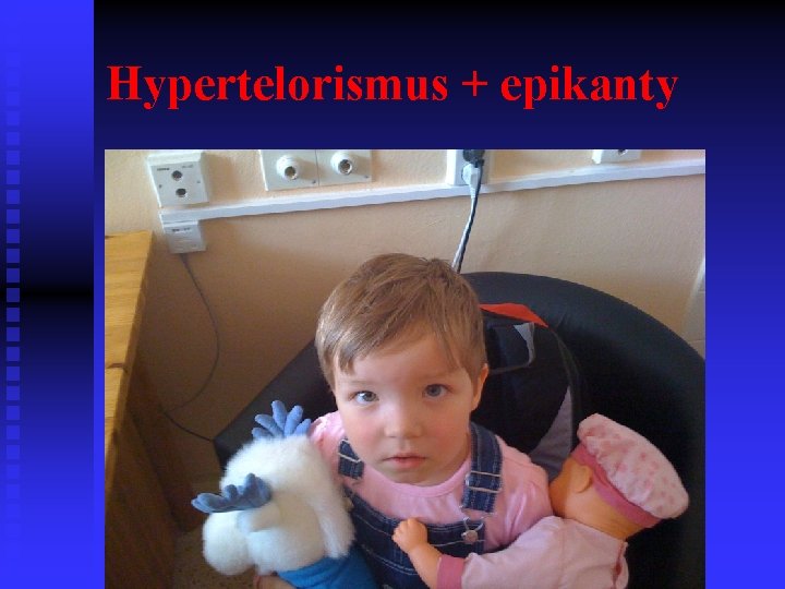 Hypertelorismus + epikanty 