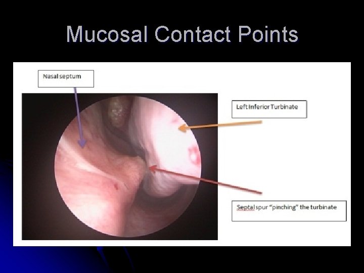 Mucosal Contact Points 