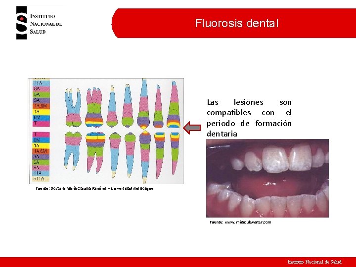 Fluorosis dental Las lesiones son compatibles con el periodo de formación dentaria Fuente: Doctora Fluorosis dental Las lesiones son compatibles con el periodo de formación dentaria Fuente: Doctora