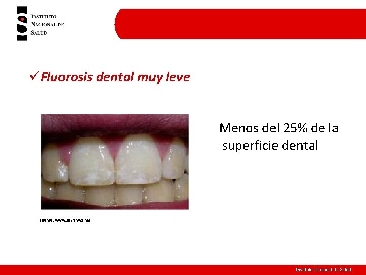 üFluorosis dental muy leve Menos del 25% de la superficie dental Fuente: www. 1984 üFluorosis dental muy leve Menos del 25% de la superficie dental Fuente: www. 1984