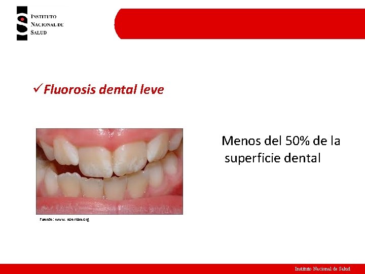 üFluorosis dental leve Menos del 50% de la superficie dental Fuente: www. noeman. org