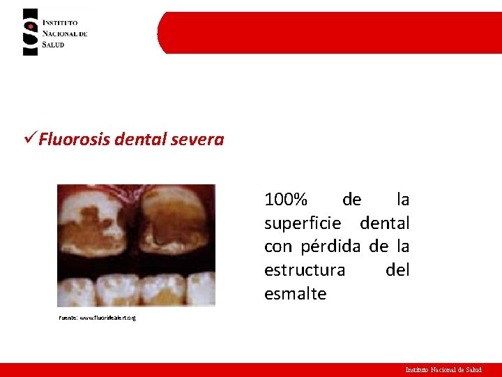 üFluorosis dental severa 100% de la superficie dental con pérdida de la estructura del