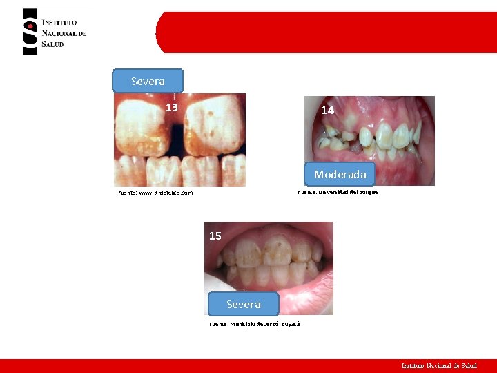 Severa 18 13 14 Moderada Fuente: Universidad del Bosque Fuente: www. drdefelice. com 20