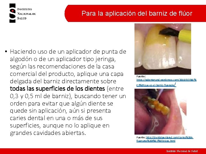 Para la aplicación del barniz de flúor • Haciendo uso de un aplicador de Para la aplicación del barniz de flúor • Haciendo uso de un aplicador de