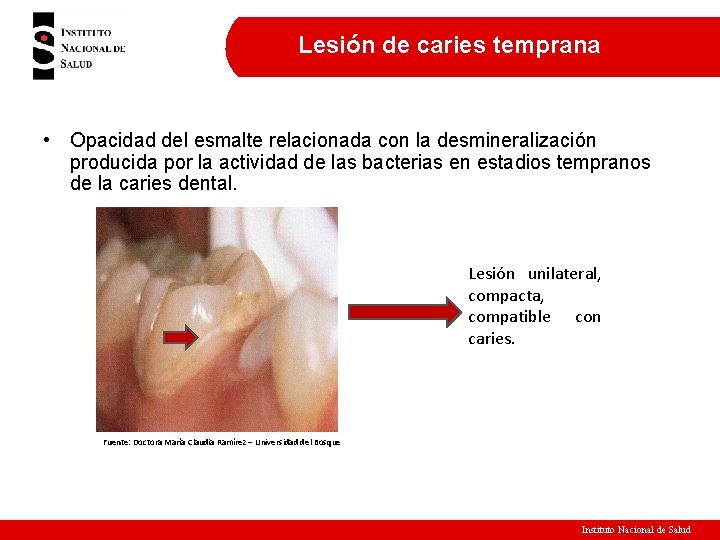 Lesión de caries temprana • Opacidad del esmalte relacionada con la desmineralización producida por