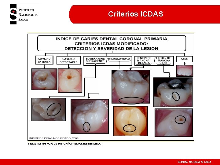 Criterios ICDAS Fuente: Doctora María Claudia Ramírez – Universidad del Bosque Instituto Nacional de